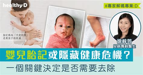 嬰兒 胎記|胎記怎麼產生、何時消除？醫師剖析胎記種類、胎記寓意